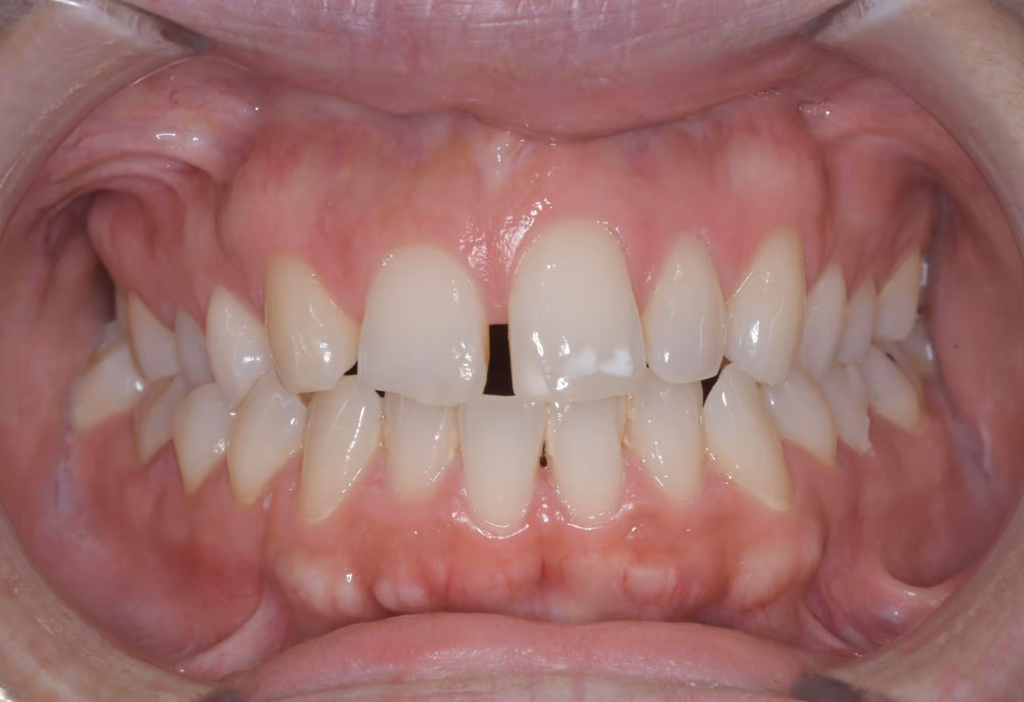 Antes del tratamiento de ortodoncia, estética e implantes